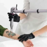 Hová tűnik a festék lézeres tetoválás-eltávolítás után – a válasz meglepőbb, mint gondolnád