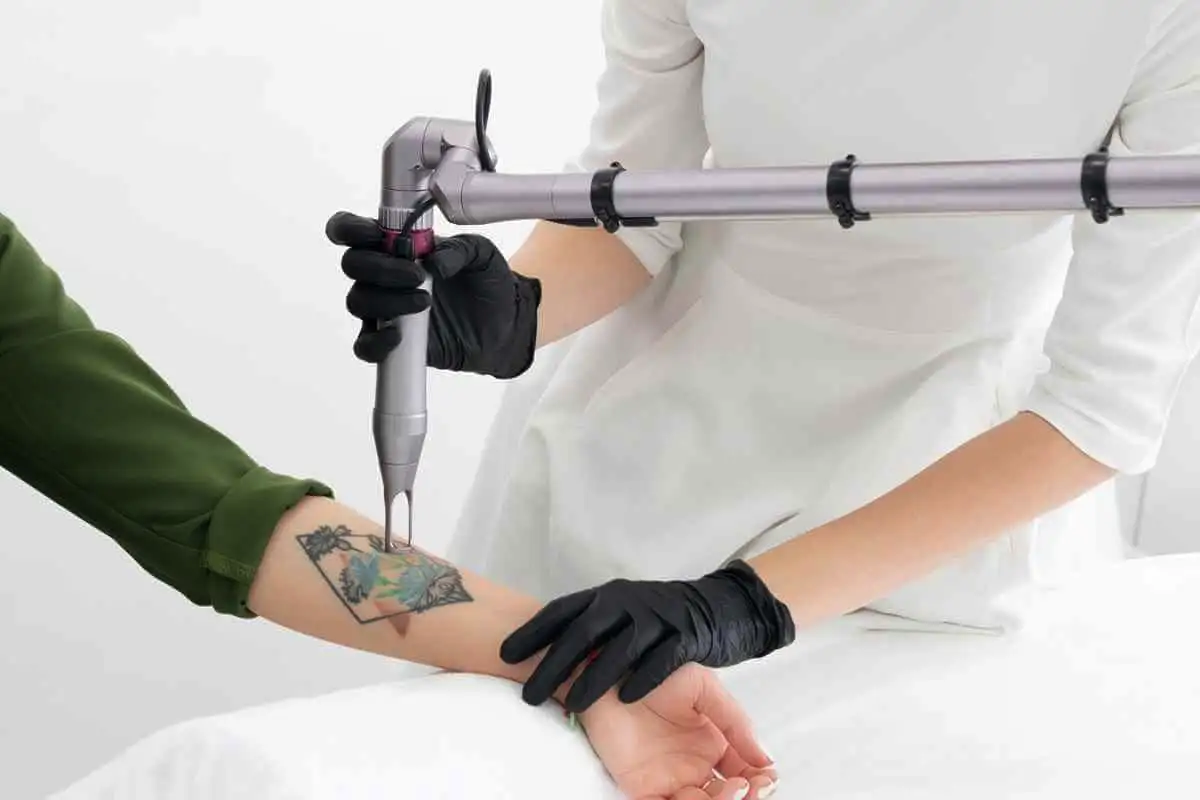 Hová tűnik a festék lézeres tetoválás-eltávolítás után – a válasz meglepőbb, mint gondolnád